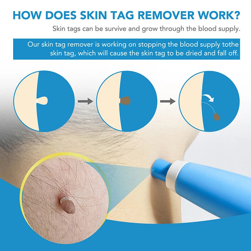 Natural Painless Auto Skin Tag Removal Kit | Mole Wart Remover Device
