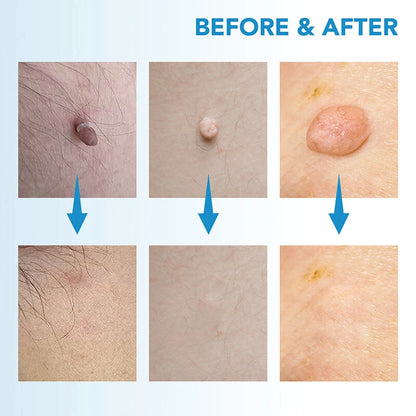 Natural Painless Auto Skin Tag Removal Kit | Mole Wart Remover Device